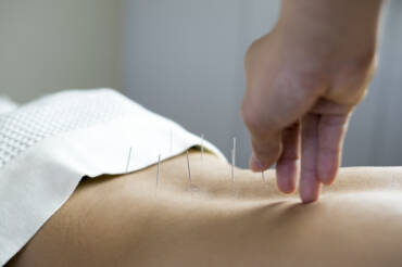 Acupuncture for Low Back Pain