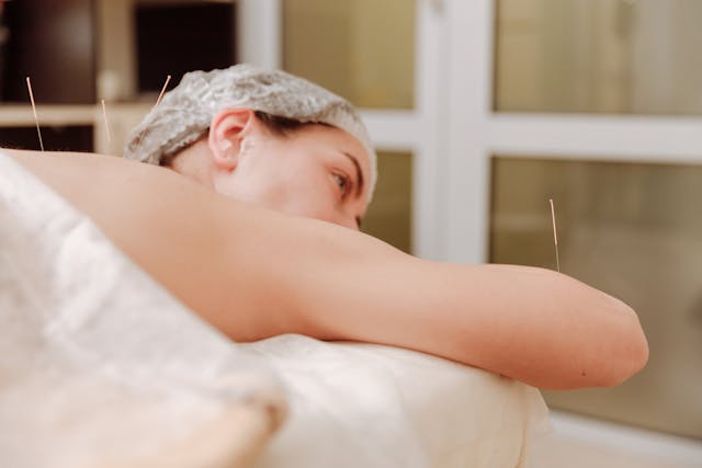 A woman lying on the table with acupuncture needles