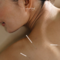 Dry Needling vs. Acupuncture: What’s the Real Difference?